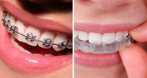 Braces Aligners