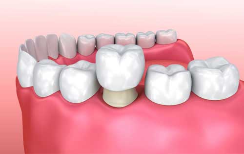 Dental Crown Types and Cost