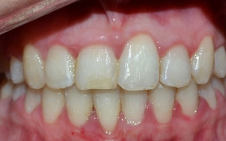 clear aligners