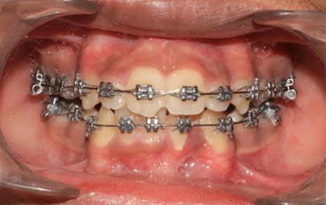 dental braces