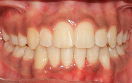 braces cost in delhi