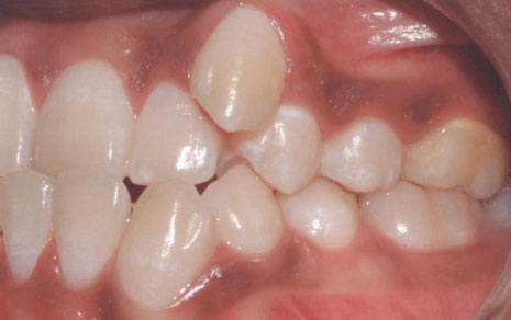 ceramic braces cost in india