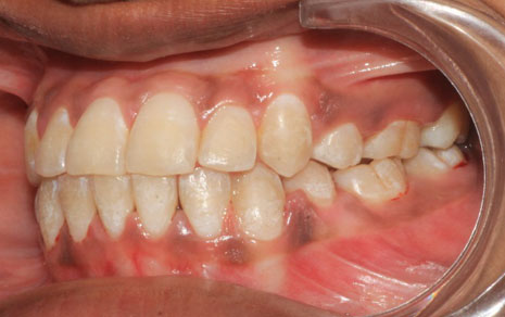 metal braces cost in india