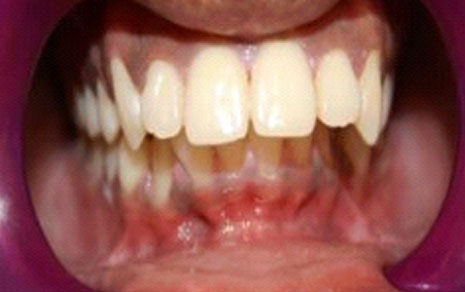 teeth braces cost in india