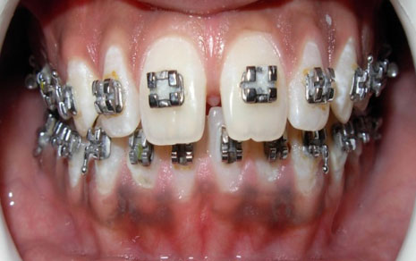 lingual braces cost in india