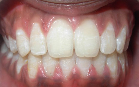 invisible braces cost in india