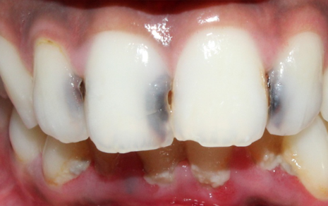 Tooth Decay Treatment