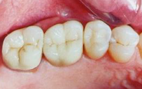 Tooth filling cost in india