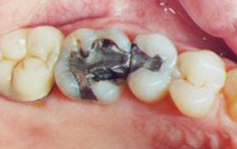 Permanent tooth filling