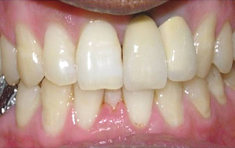 Tooth cavity filling