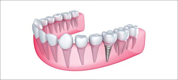 Can Anyone Get Dental Implants