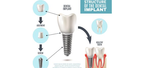Implant
