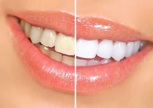 teeth whitening cost