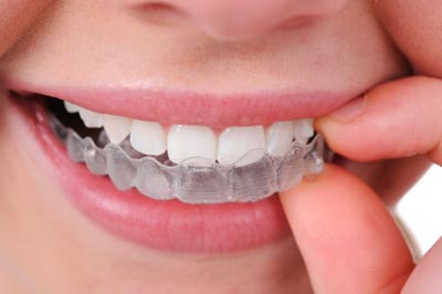 Invisalign Aligners 