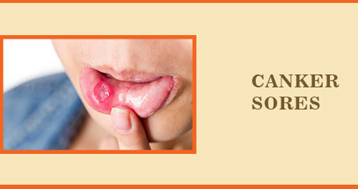 Canker Sores