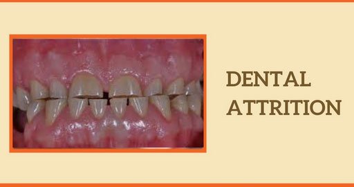 Dental Attrition