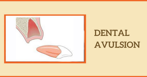 Dental Avulsion