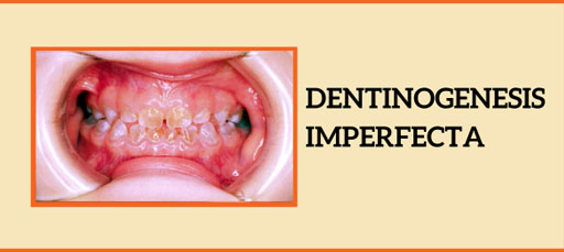 Dentinogenesis Imperfecta