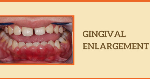 Gingival Enlargement
