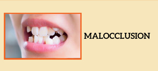 Malocclusion
