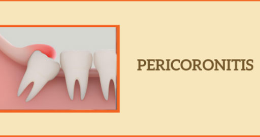 Pericoronitis