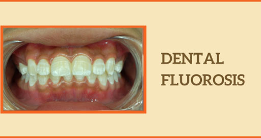 White Fluorosis Spots