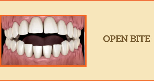 Open Bite