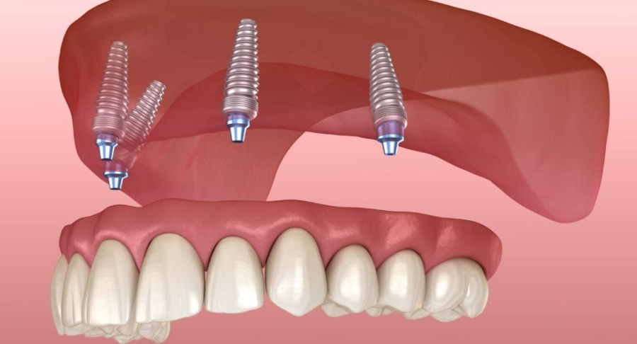 Implant Supported Dentures