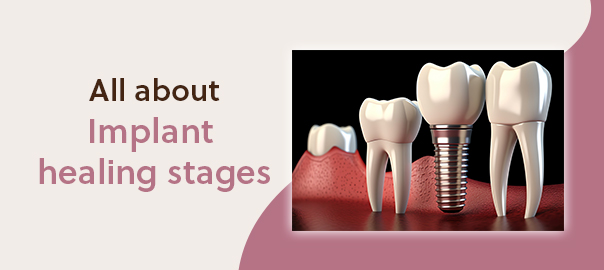 implant