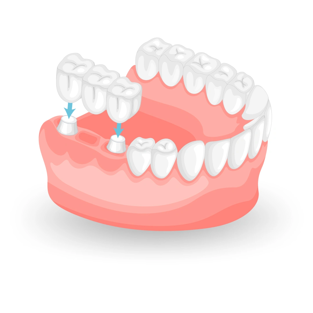 Gummy smile treatment