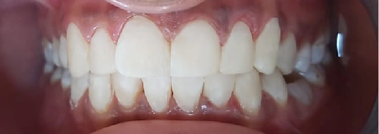 Removing soft tissue