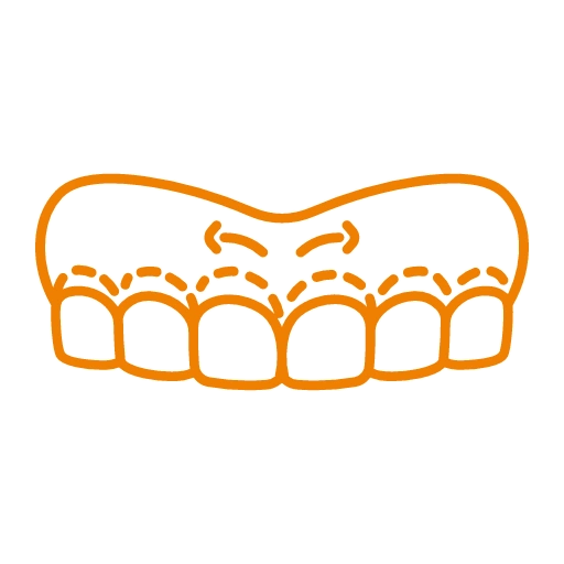 Invisalign Aligners