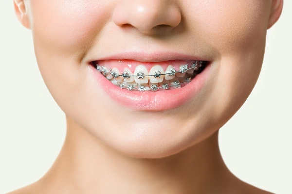 Whistle Aligners