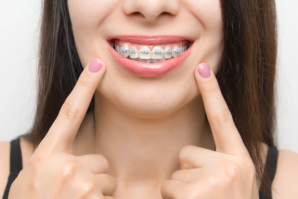 Invisalign Aligners