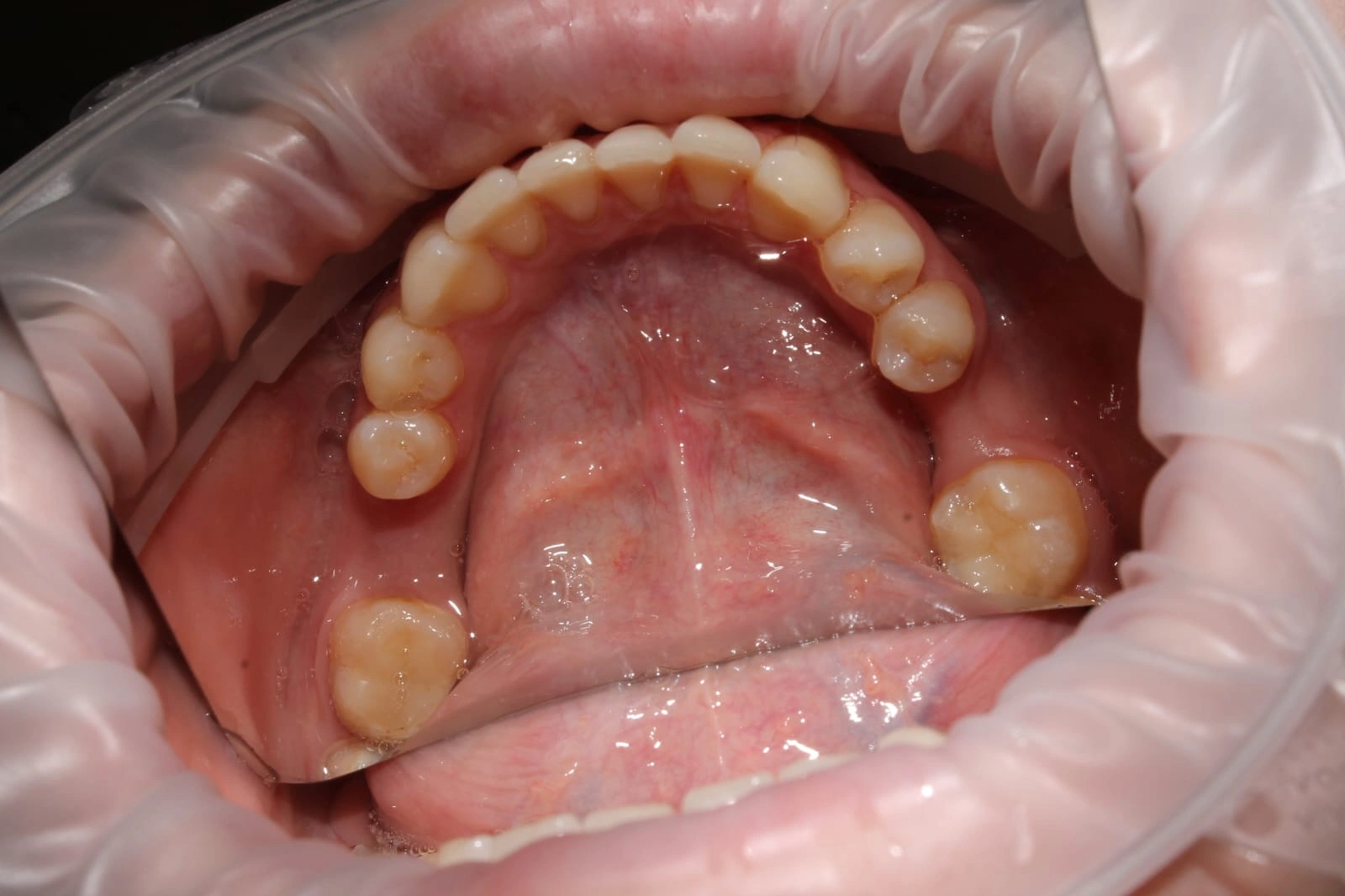 Removing soft tissue