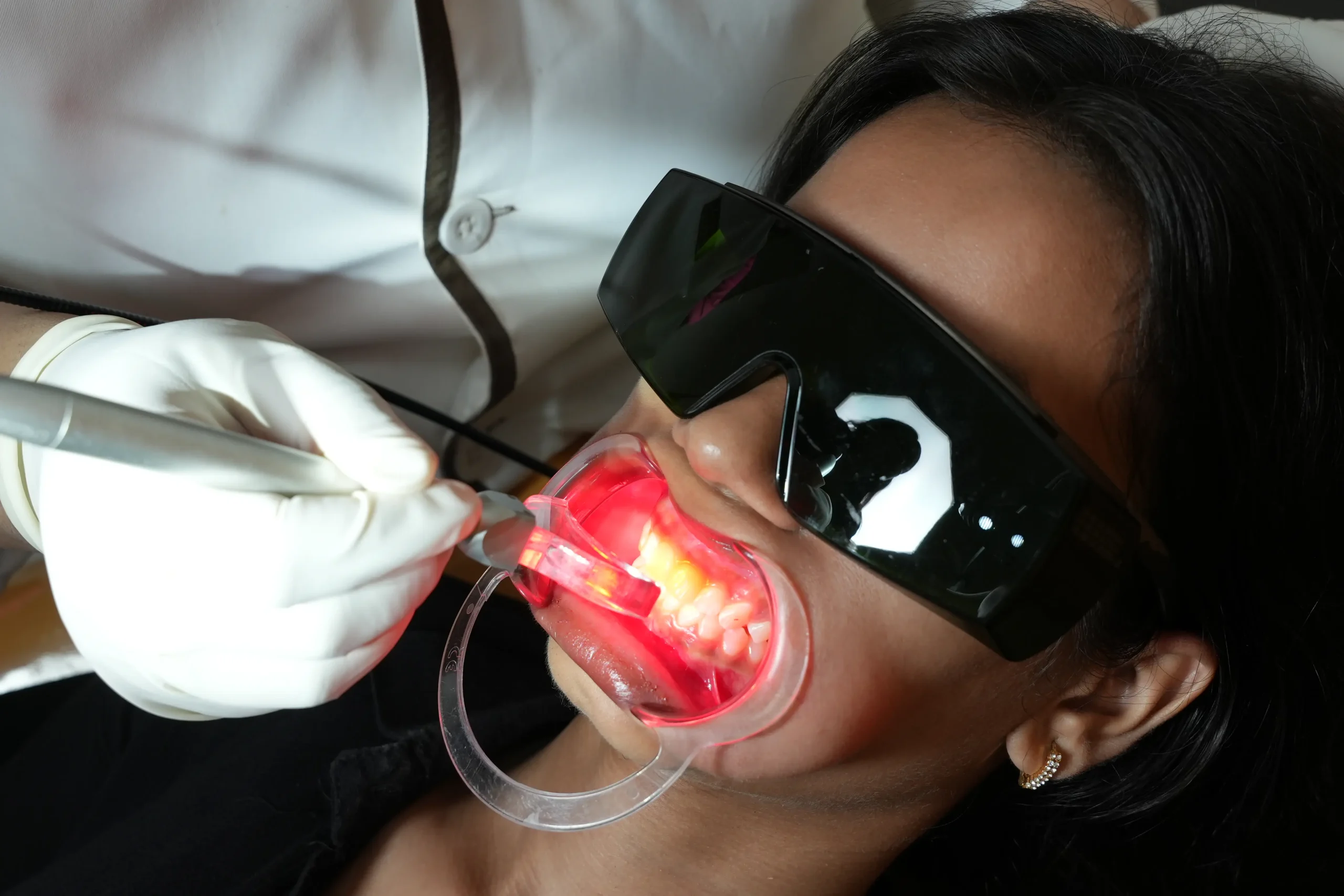 Gummy smile treatment