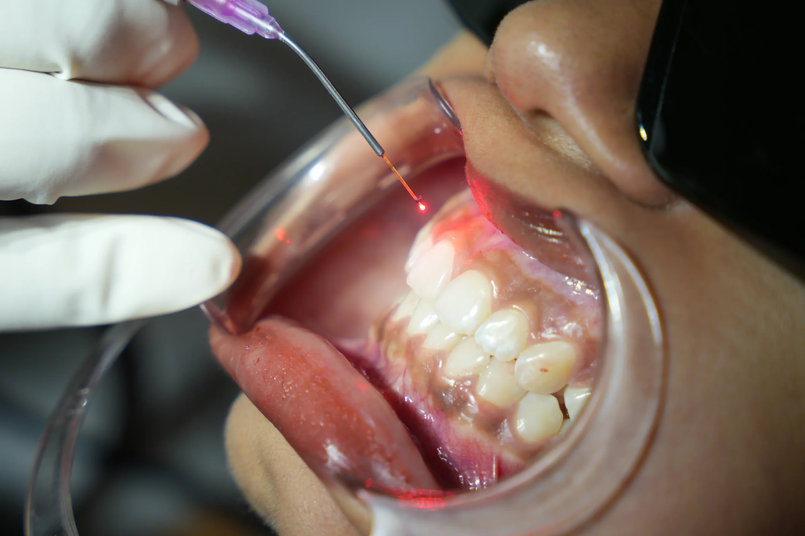 Gummy smile treatment