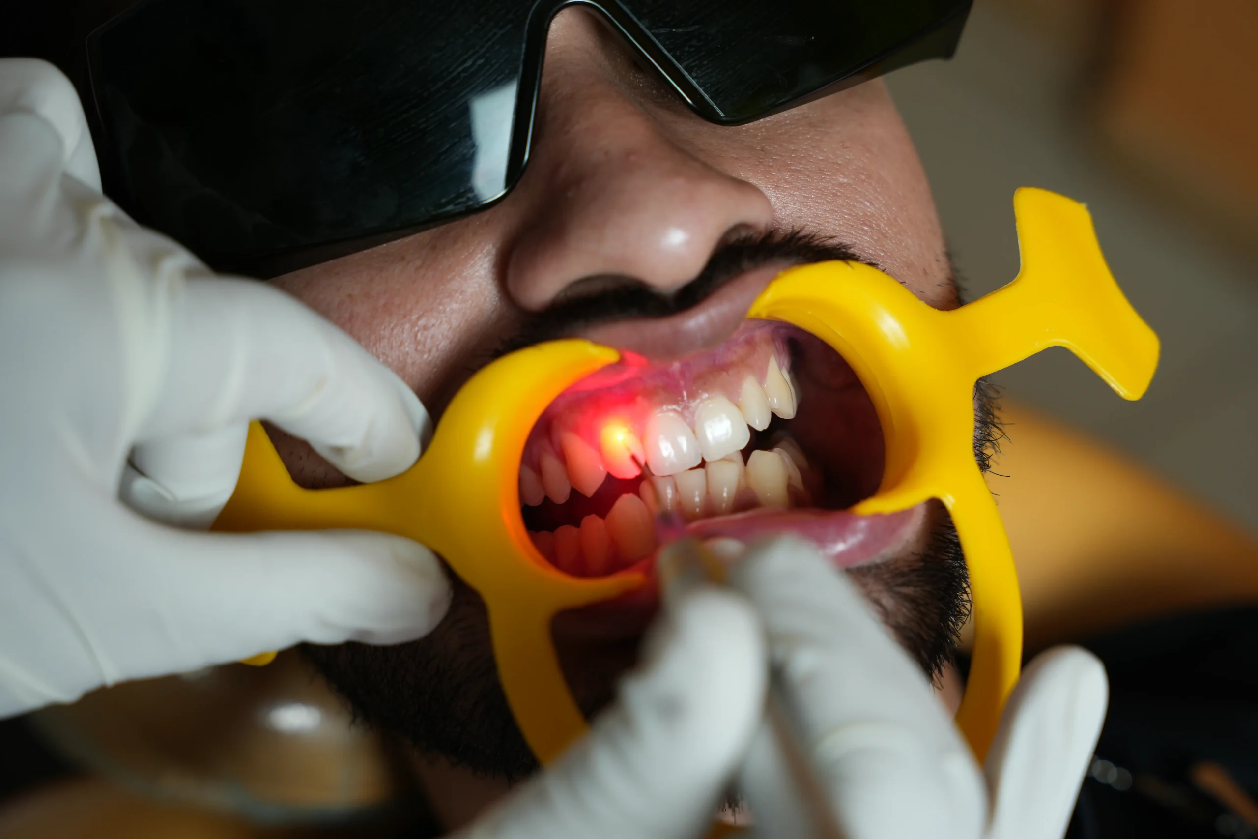 Gummy smile treatment