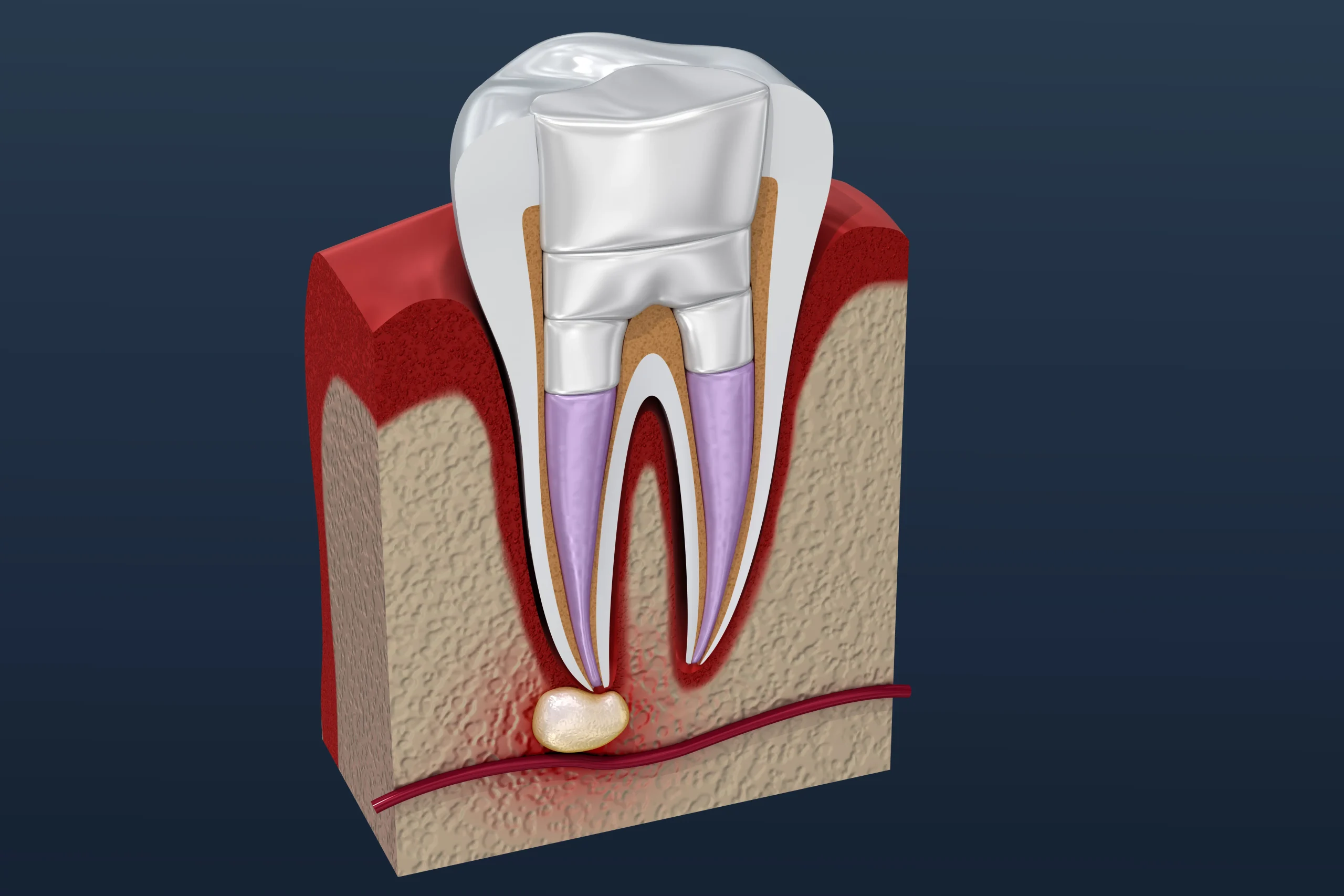 Treating tongue frenulum